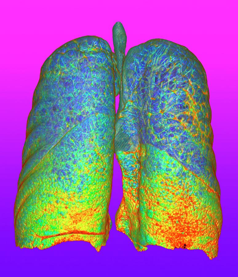 Smokers Lungs And Emphysema Photograph By K H Fungscience Photo Library Fine Art America