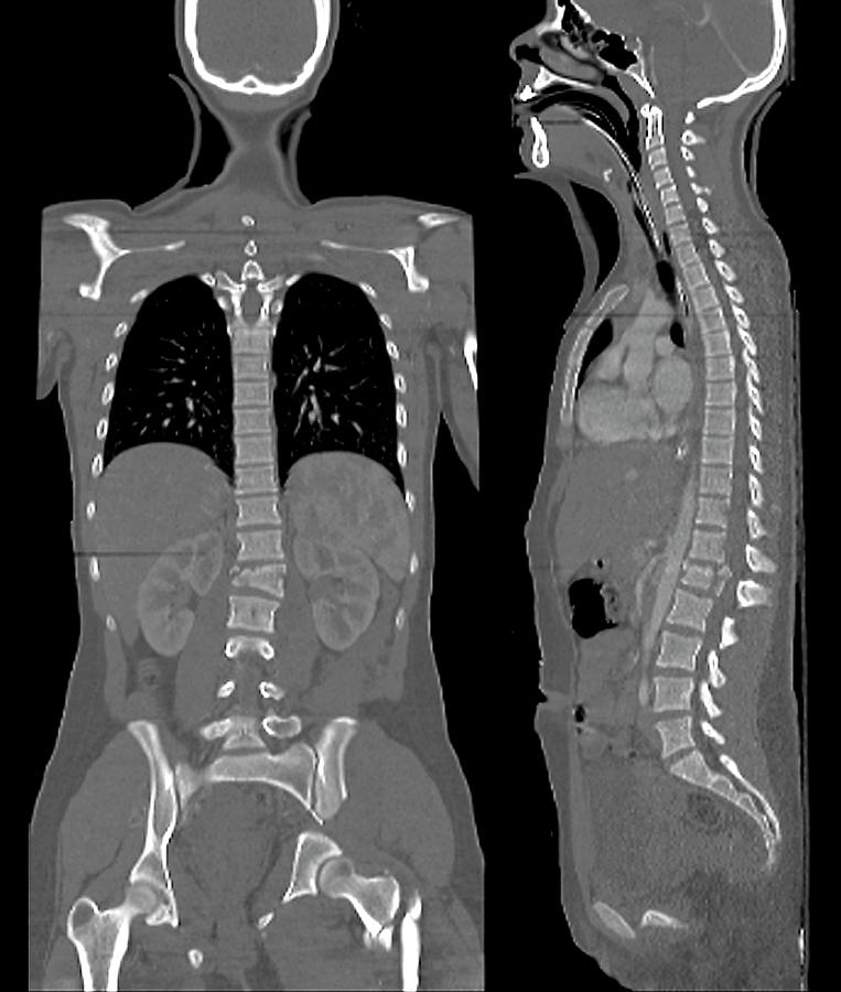 bone fracture pelvic bone fracture pelvic