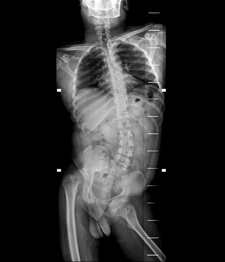 Spinal Deviation In Polio Photograph by Zephyr/science Photo Library ...