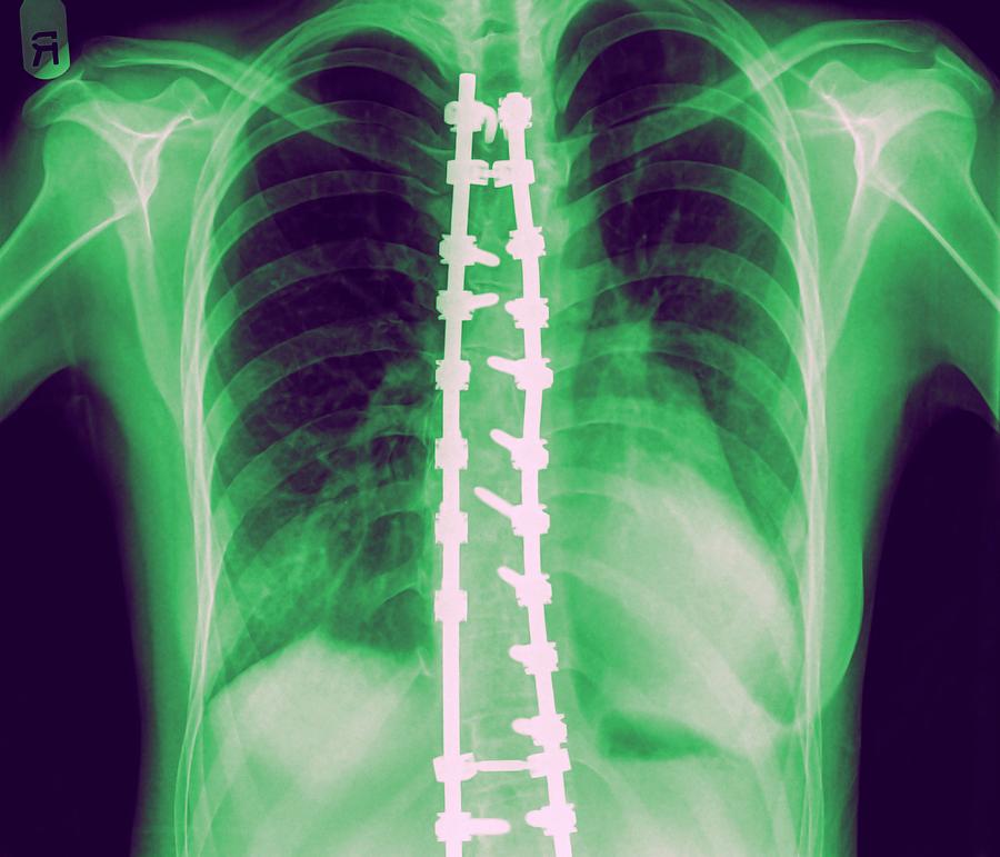 Skeleton Photograph - Spinal Fusion #2 by Photostock-israel