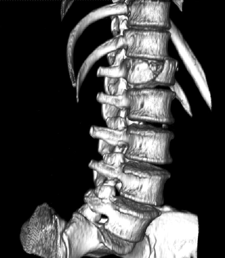 Injury Photograph - Spinal Injury #2 by Zephyr/science Photo Library