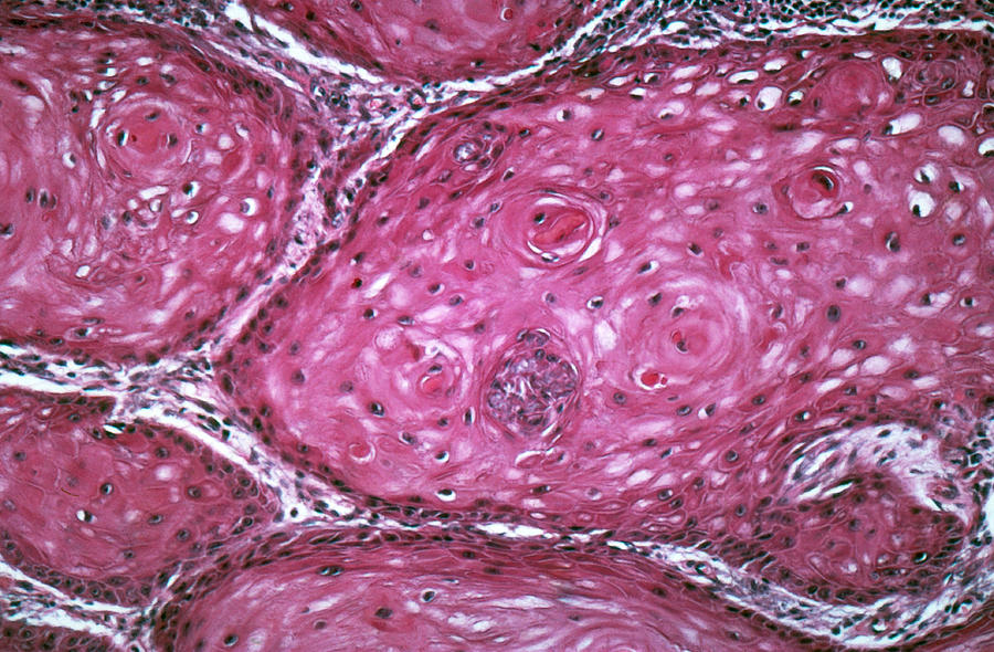 Squamous Cell Carcinoma, Lm #2 Photograph by Michael Abbey