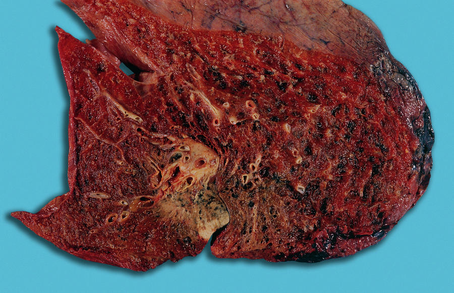 Squamous Cell Carcinoma Photograph - Squamous Cell Carcinoma Lung Cancer #2 by Medimage/science Photo Library