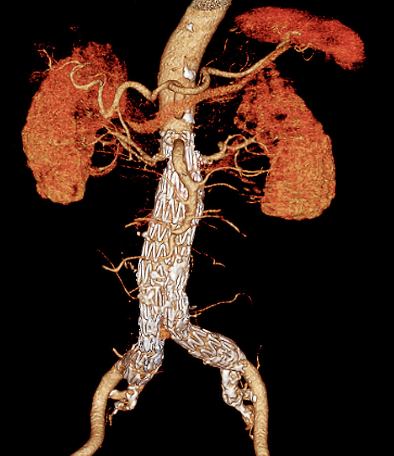 Abdominal Aorta Stent