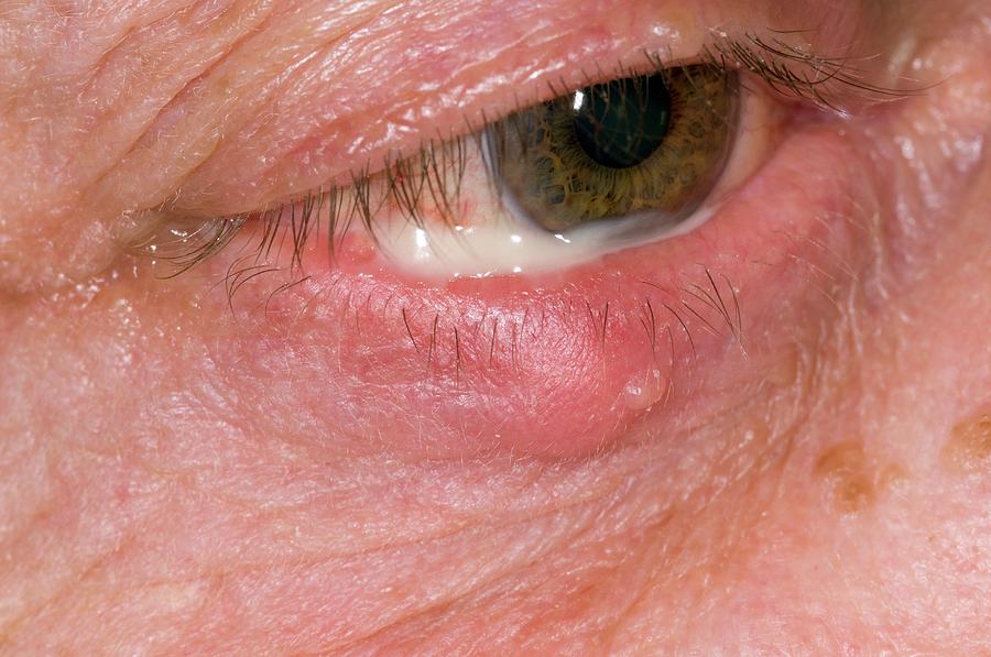 Stye On The Lower Eyelid Photograph By Dr P Marazziscience Photo Library