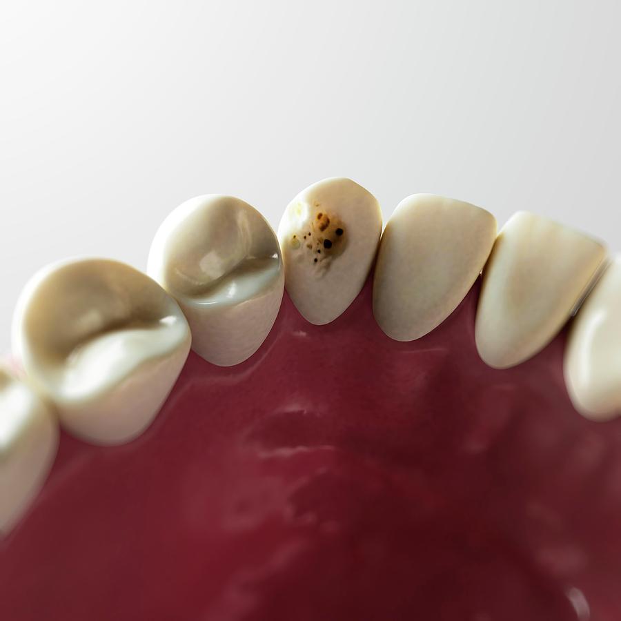 Tooth Decay #2 Photograph by Sciepro/science Photo Library
