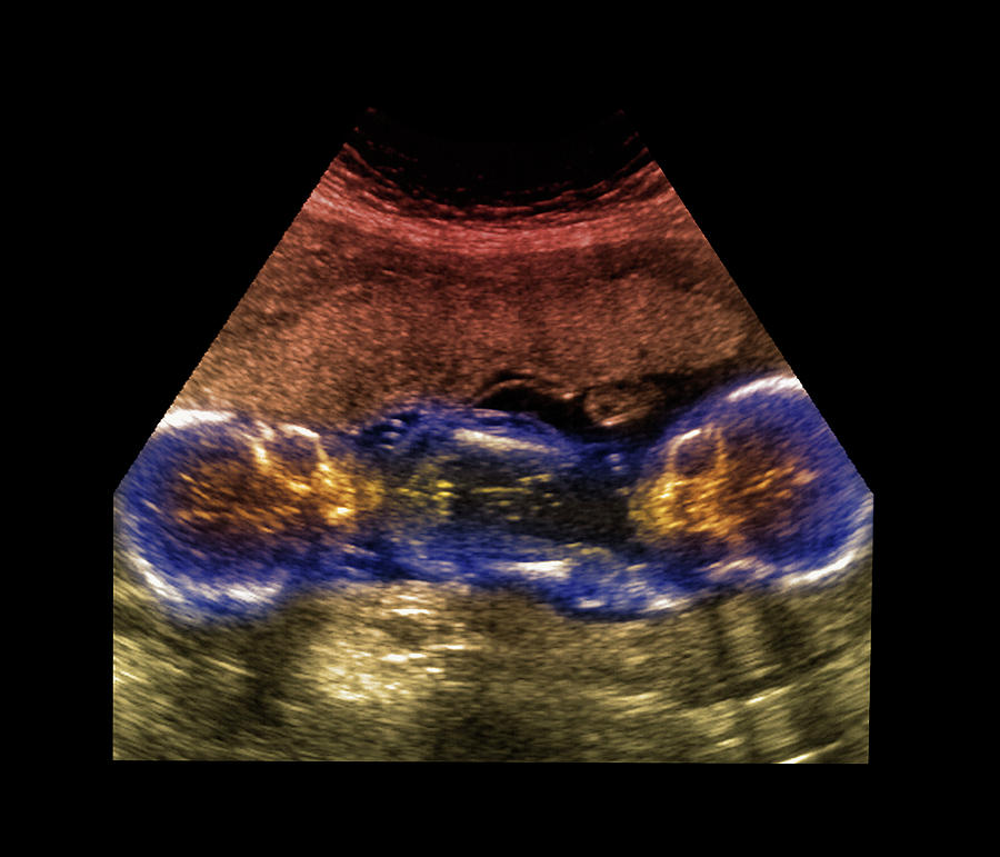 Medicine Photograph - Twin Foetuses #2 by Science Photo Library