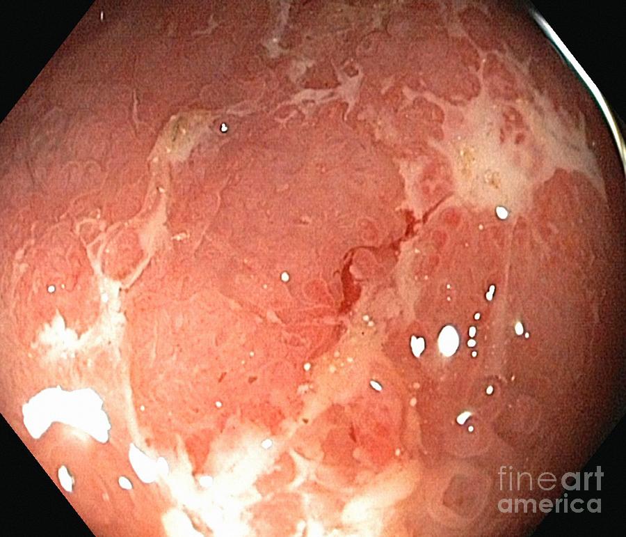 Digestive System Photograph - Ulcerative Colitis, Endoscopic View #2 by Gastrolab