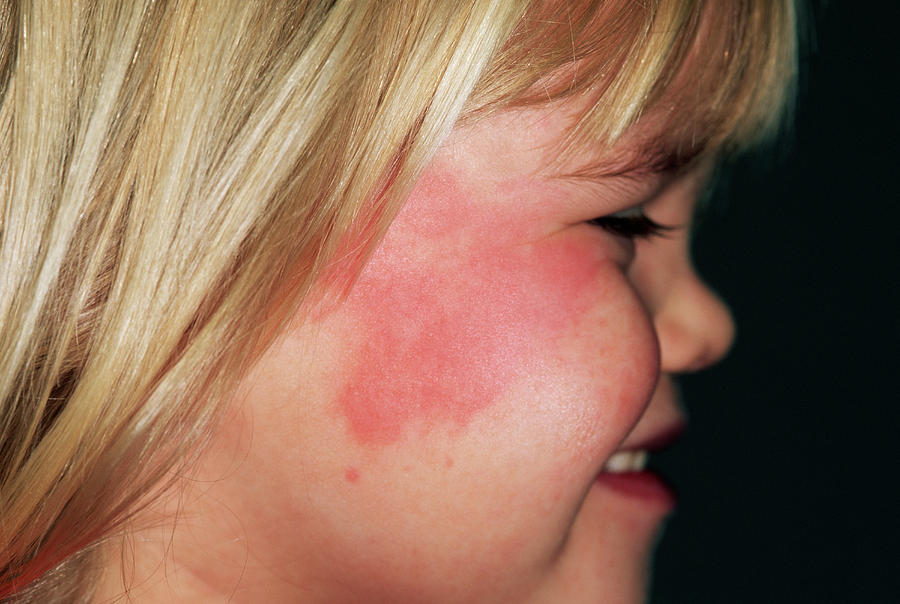 Urticaria Rash Photograph By Dr P Marazzi Science Photo Library