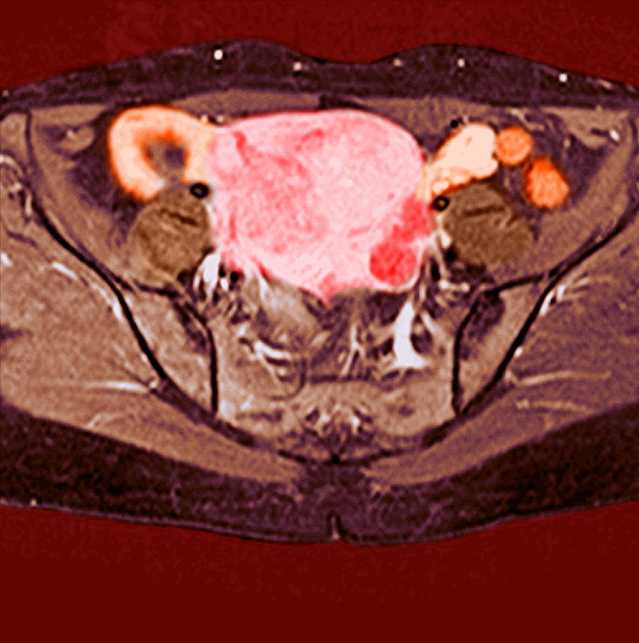 Uterine Fibroid #2 by Science Photo Library