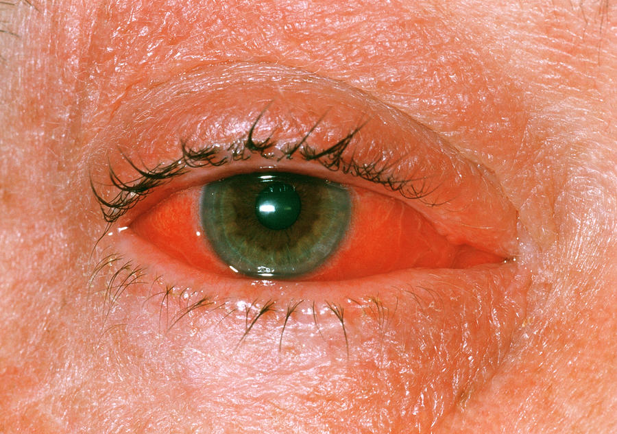 Viral Conjunctivitis Photograph By Dr P Marazziscience Photo Library 