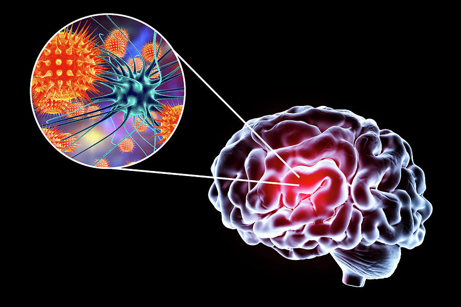 case study viral encephalitis