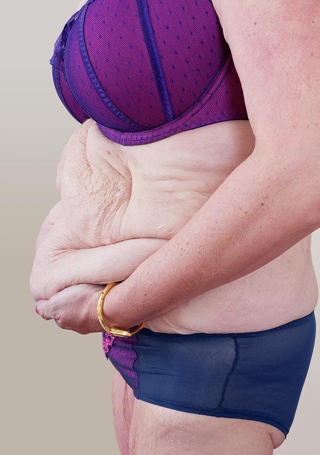 Woman With Excess Skin After Weight Loss Photograph By Science Photo Library 6993