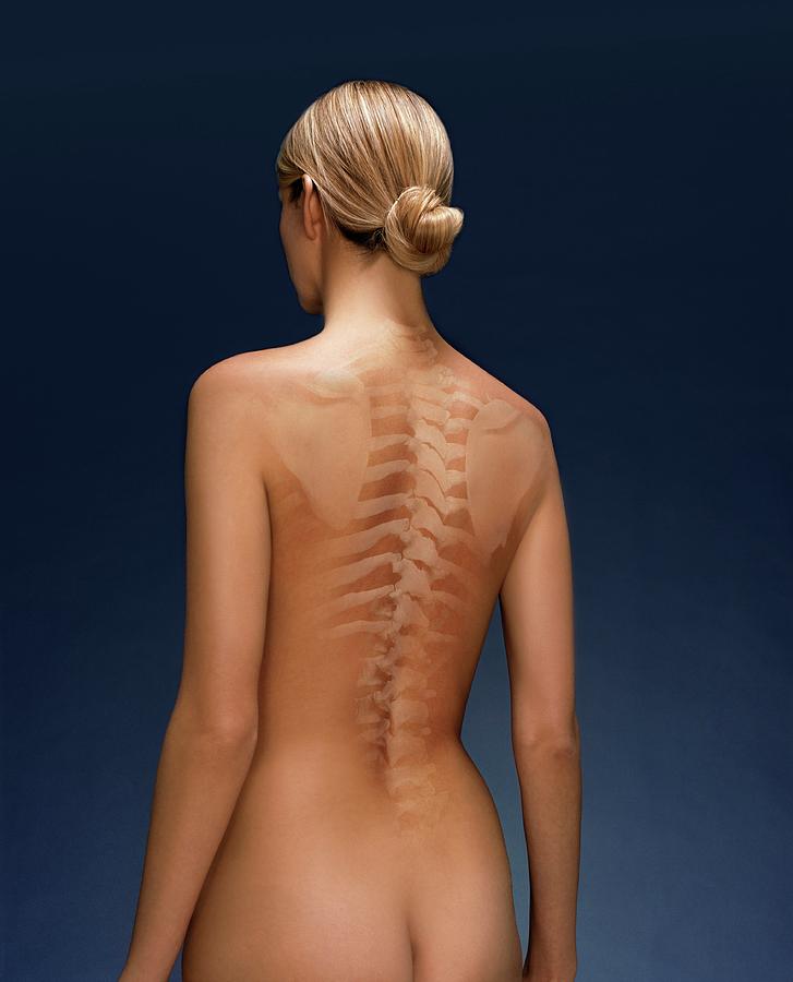 Woman's Back #2 by Kate Jacobs/science Photo Library