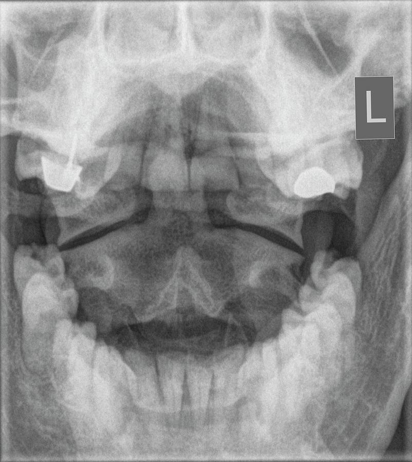 X-ray Of A Human Cervical Spine #2 by Photostock-israel