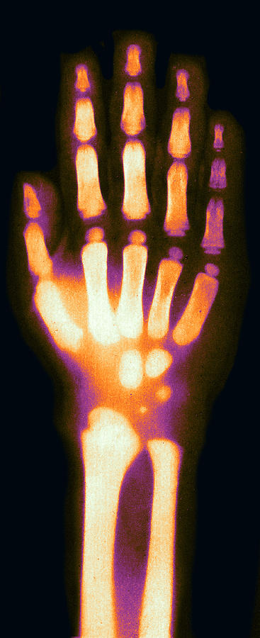 X-ray Of Childs Hand, 1896 #2 Photograph by Science Source