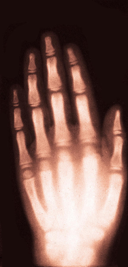 X-ray Of Girls Hand, 1896 #2 Photograph by Science Source