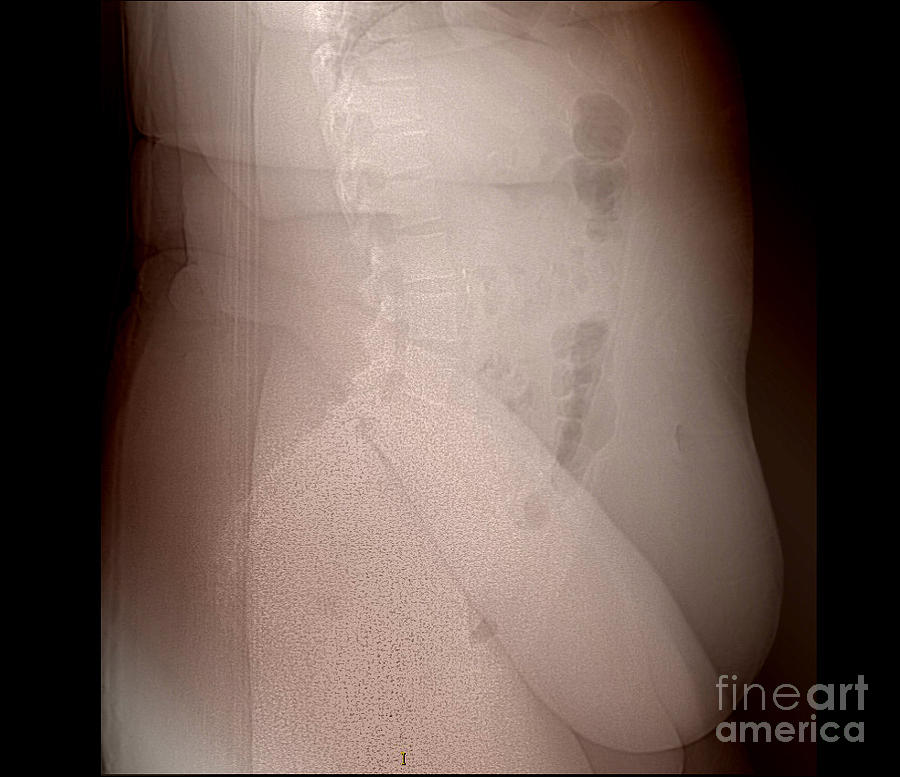 X-ray Of Morbidly Obese Patient #2 Photograph by Living Art Enterprises
