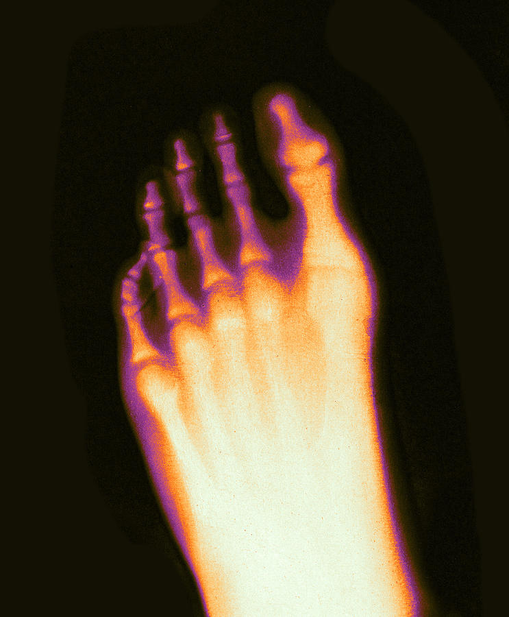X-ray Of Teenage Boys Foot, 1896 #2 Photograph by Science Source