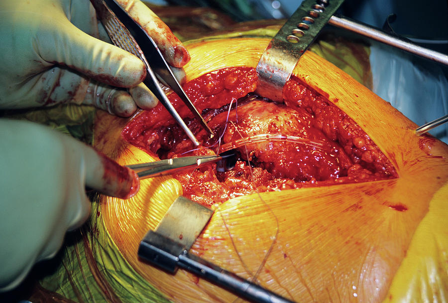 Hip Replacement Surgery #20 Photograph by Antonia Reeve/science Photo Library