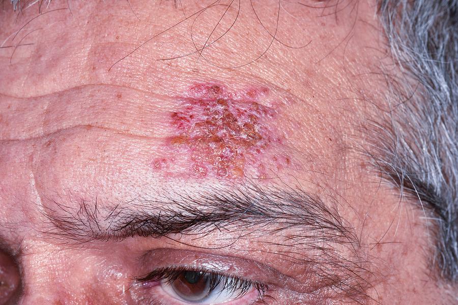 Shingles Rash On The Head Photograph By Dr P Marazzi Science Photo Library Hot Sex Picture 