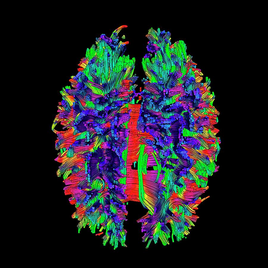 Brain Tumour #22 Photograph by Simon Fraser/science Photo Library
