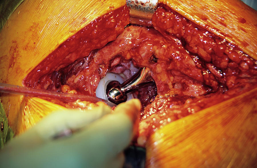 Hip Replacement Surgery #22 Photograph by Antonia Reeve/science Photo Library