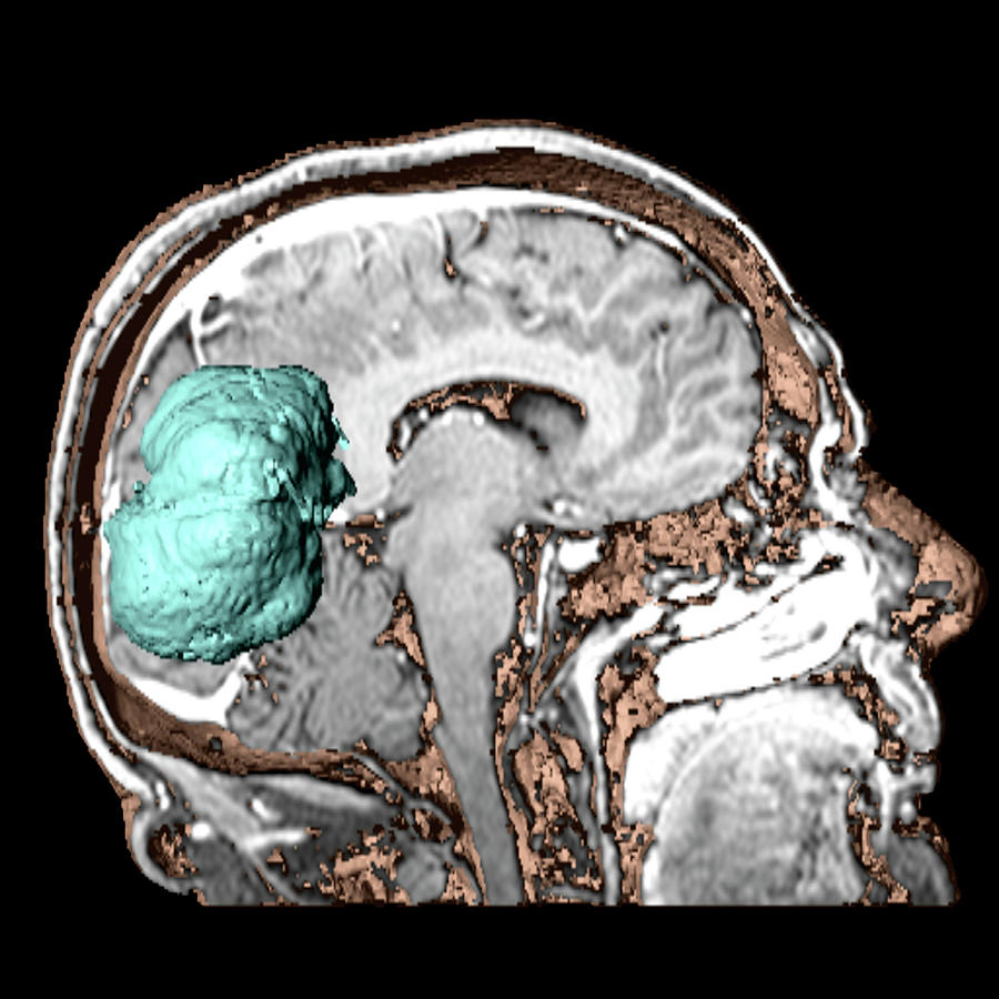 Brain Tumour 23 By Simon Fraserscience Photo Library 6745