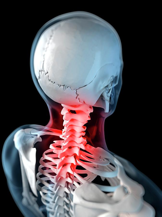 Neck Pain Photograph By Sciepro/science Photo Library | Fine Art America