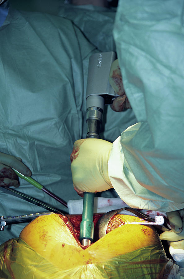 Hip Replacement Surgery #25 Photograph by Antonia Reeve/science Photo Library