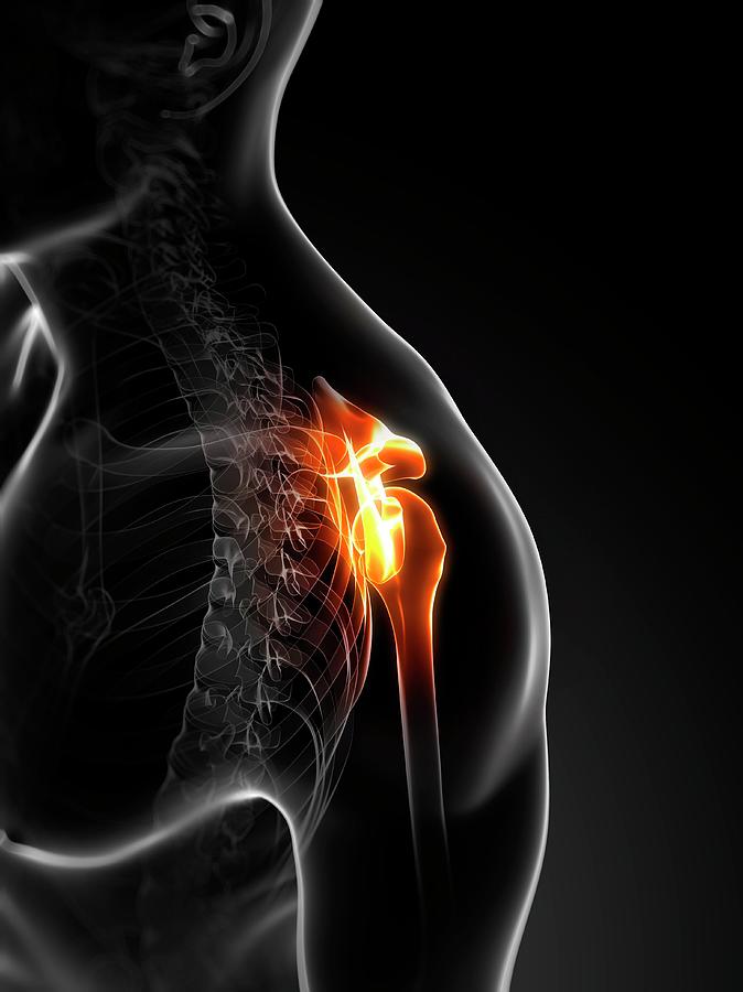 Shoulder Pain Photograph by Sciepro/science Photo Library - Fine Art ...