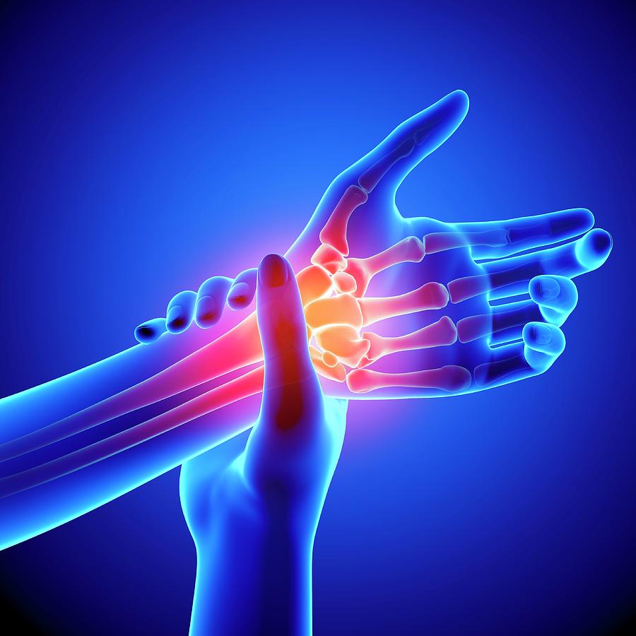 Wrist Pain Photograph By Pixologicstudio Science Photo Library - Fine 