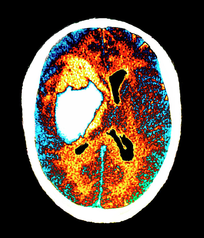 Stroke #26 Photograph by Zephyr/science Photo Library