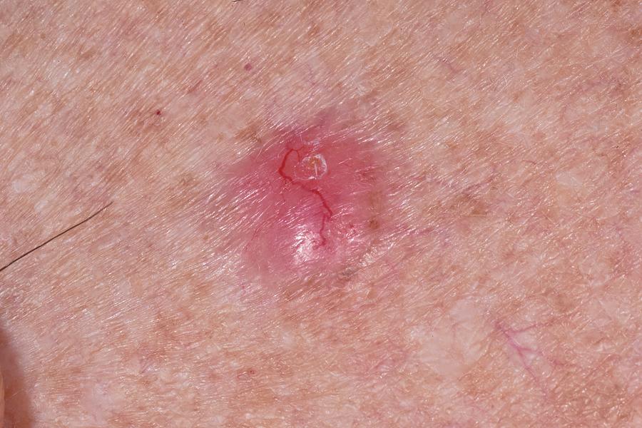 Basal Cell Carcinoma Skin Cancer Photograph By Dr P Marazzi Science