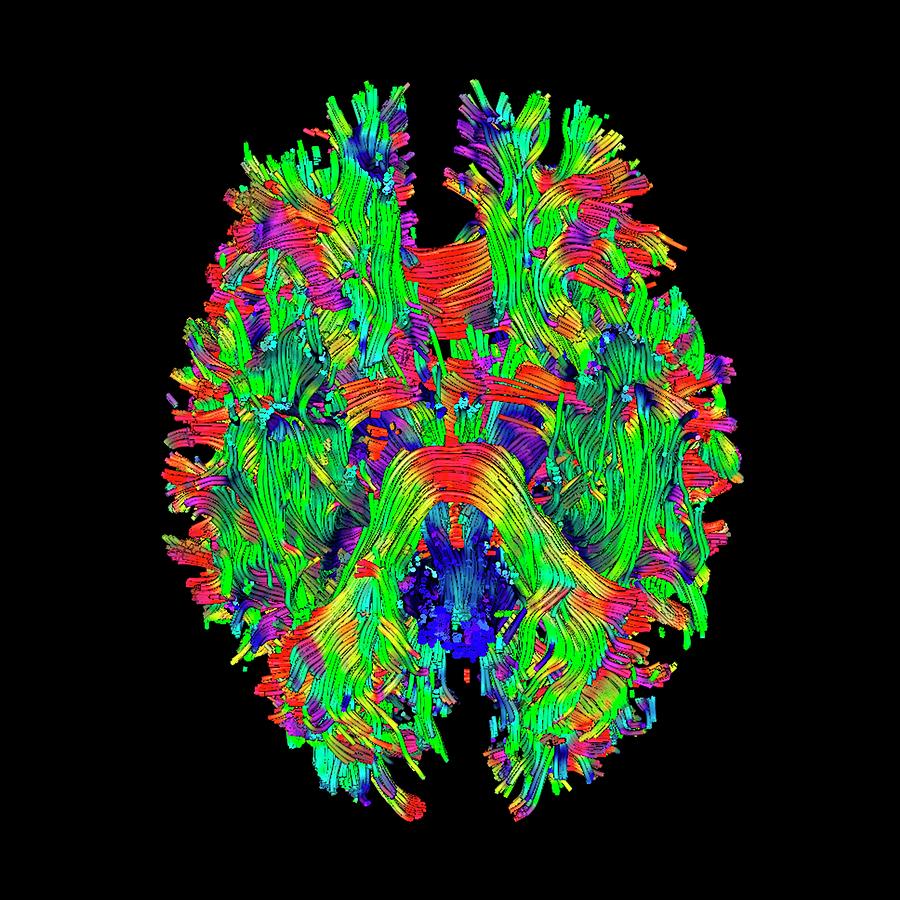 Map Photograph - Brain Tumour #27 by Simon Fraser/science Photo Library
