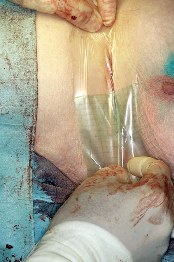 Equipment Photograph - Breast Cancer Surgery by Dr P. Marazzi/science Photo Library Equipment Photograph - Breast Cancer Surgery by Dr P. Marazzi/science Photo Library