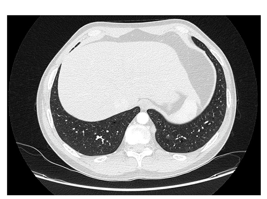 Lungs #28 by Asklepios Medical Atlas