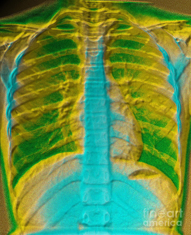 A Normal Chest X-ray #3 Photograph by Scott Camazine