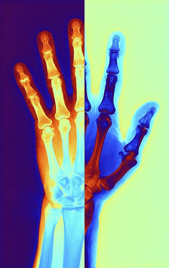 Arthritic Hand Photograph By Alfred Pasieka/science Photo Library ...