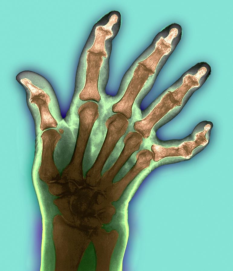 Arthritic Hand #3 Photograph by Zephyr/science Photo Library - Pixels