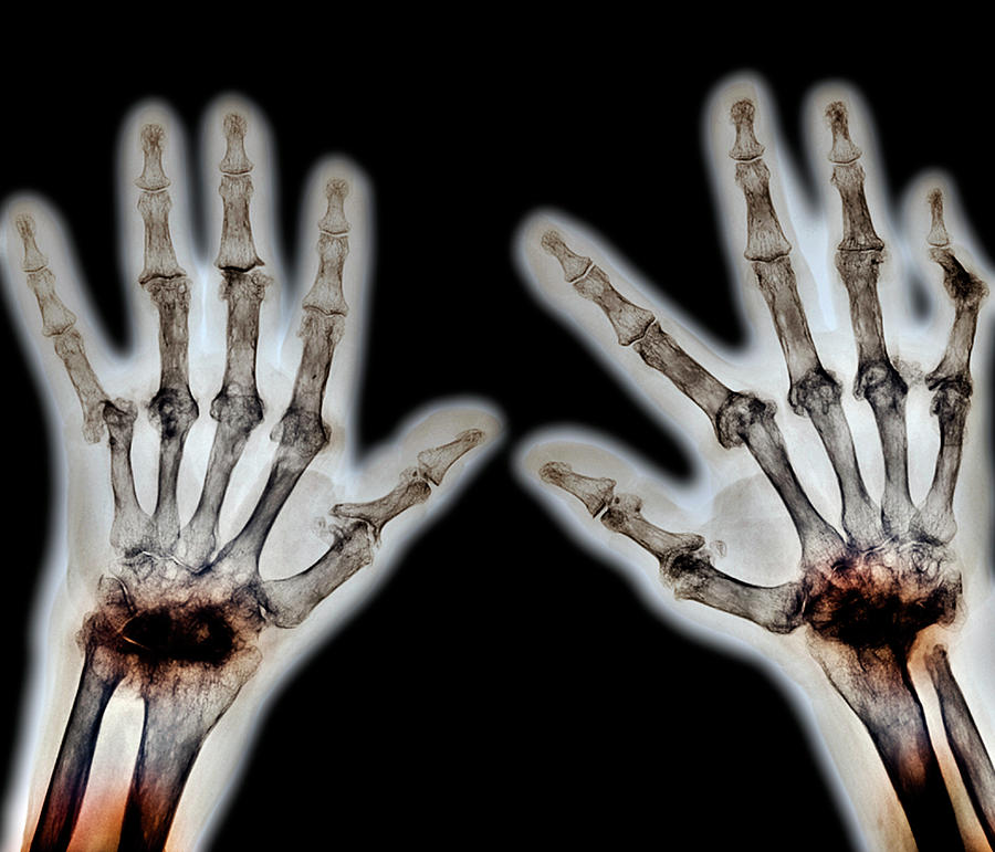 arthritic-hands-photograph-by-zephyr-science-photo-library-fine-art