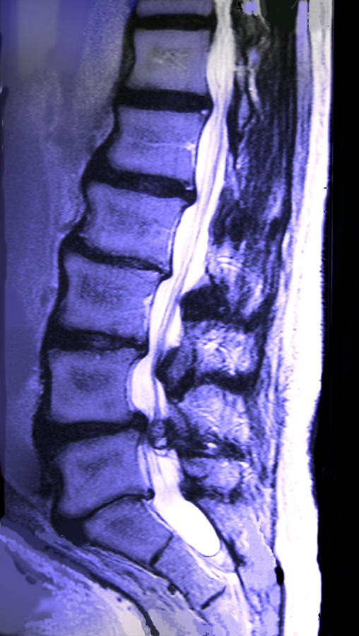 Arthritic Spine #3 Photograph by Chris Bjornberg