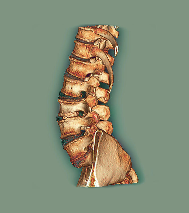 Arthritis Of The Spine Photograph by Zephyr/science Photo Library