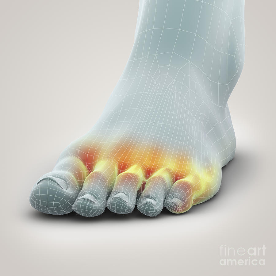 Infection Photograph - Athletes Foot #3 by Science Picture Co