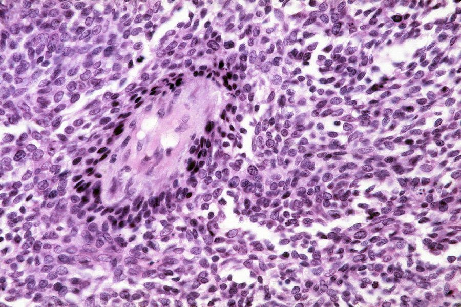 Basal-cell Carcinoma, Lm #3 Photograph by Michael Abbey
