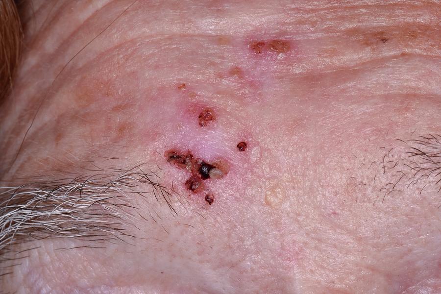 Basal Cell Carcinoma Skin Cancer Photograph By Dr P Marazzi Science