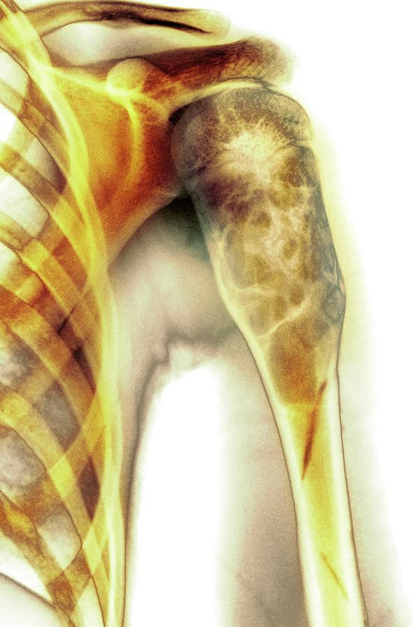 Benign Bone Cyst Photograph by Mike Devlin Pixels