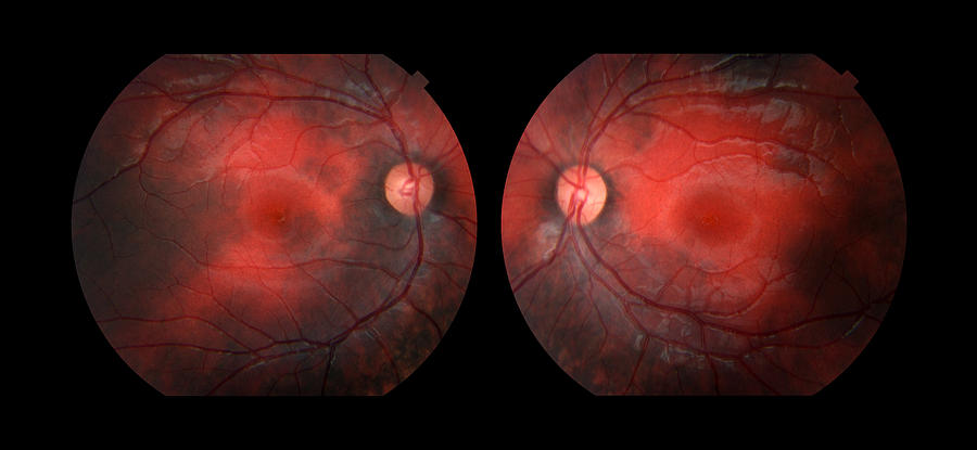 Bilateral Melanosis Of Eye #3 Photograph by Paul Whitten