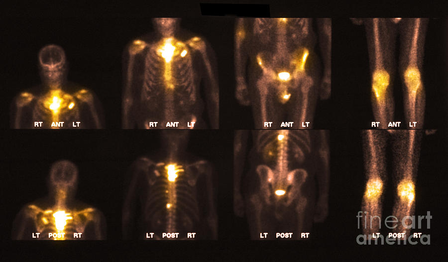 Bone Scan Showing Multiple Metastases #3 Photograph by Scott Camazine