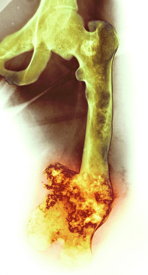 Bone Tumour Photograph by Mike Devlin - Fine Art America